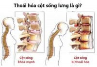 Thoái hóa đốt sống lưng là gì? cách phòng ngừa hiệu quả