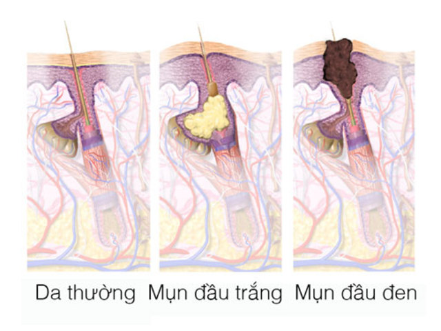 Phân biệt sợi bã nhờn và mụn đầu đen bạn có biết