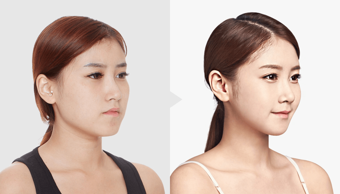 Tiêm botox làm gọn hàm giữ được bao lâu?