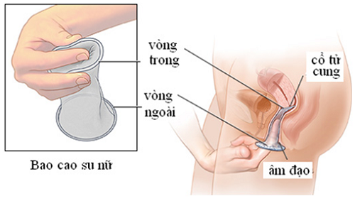 Bao cao su cho phái nữ bảo bối giúp tránh thai và ngừa bệnh tình dục